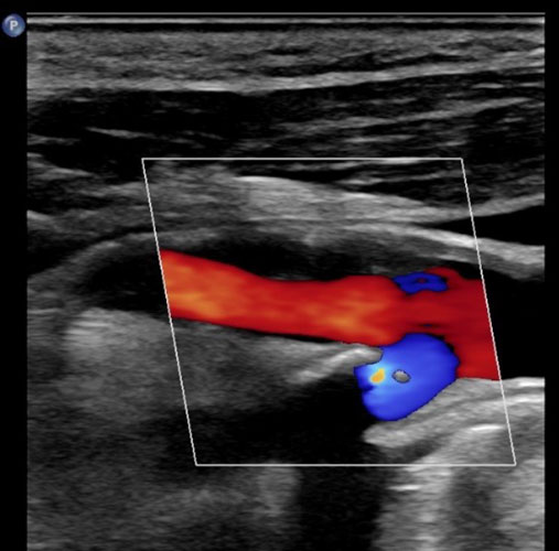 An internal carotid artery in longitudinal view, less than 50% stenosis