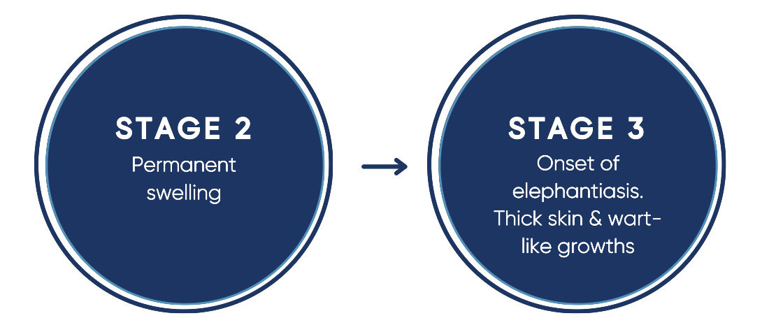 Stages of lymphoedema: Stage 2 & Stage 3