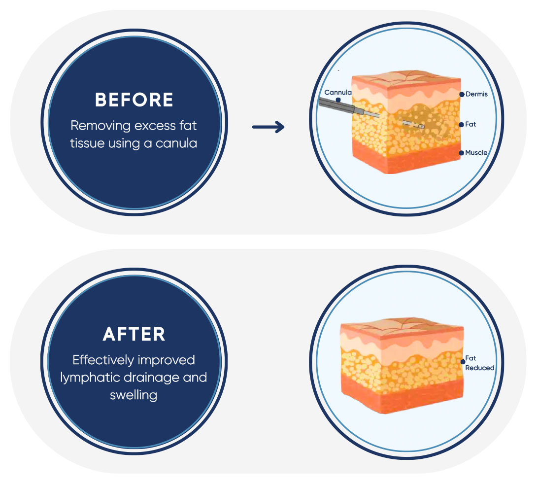 Liposuction process