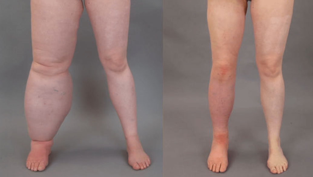 Photo demonstrating lymphoedema of the left hand