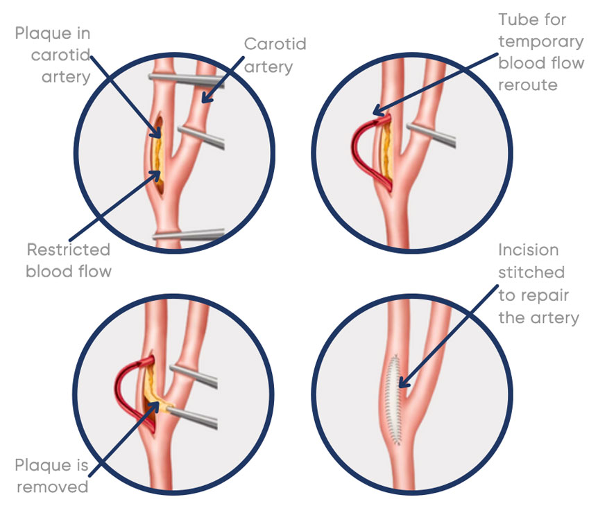 This open surgical procedure involves the removal of plaque from inside the carotid artery to restore blood flow.