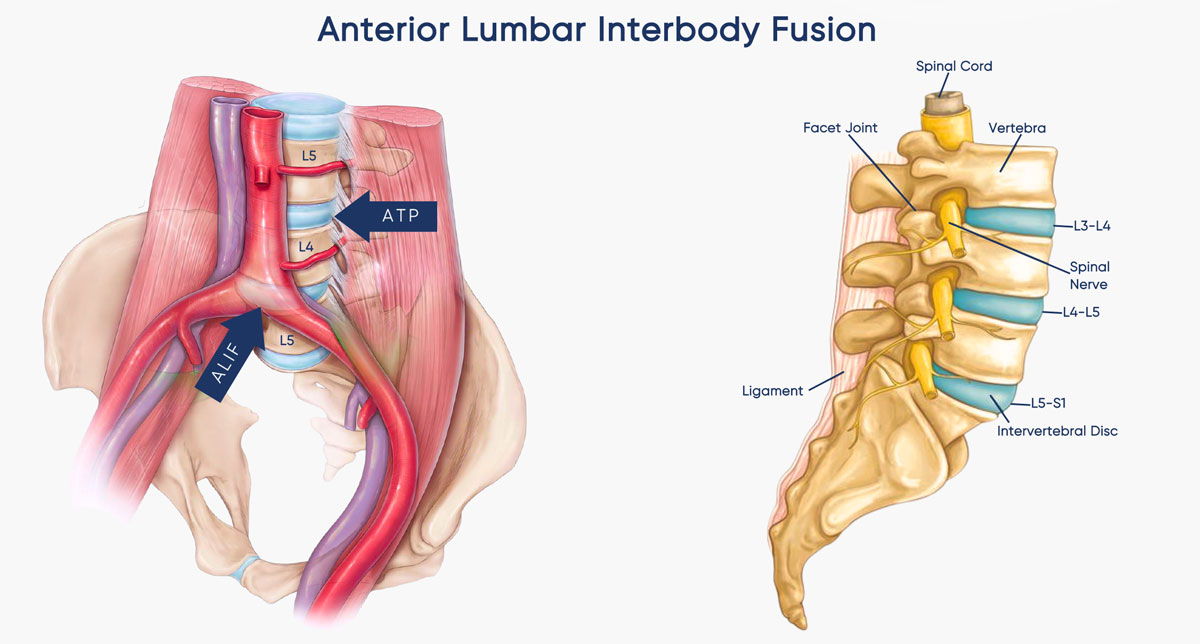 Anterior Lumbar Interbody Fusion