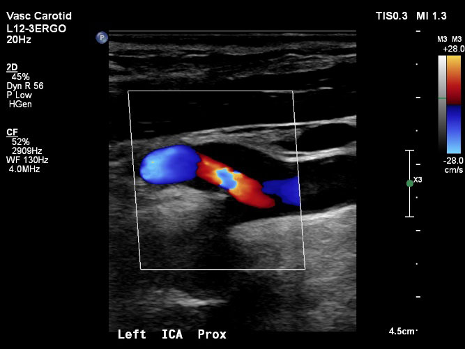 An internal carotid artery with a moderate to severe stenosis (70-79%)