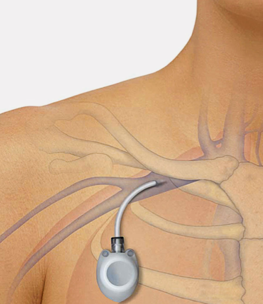 Port a Cath Post Op Instructions Dr Mayo Theivendran Port a Cath Post Op Instructions Dr Mayo Theivendran