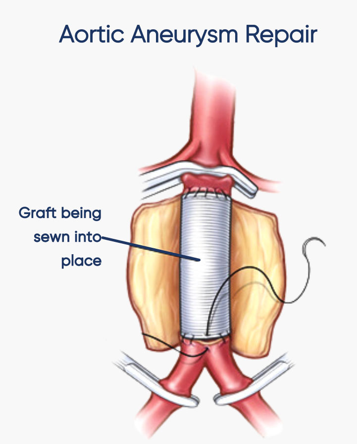 Aortic Aneurysm Repair in Sydney
