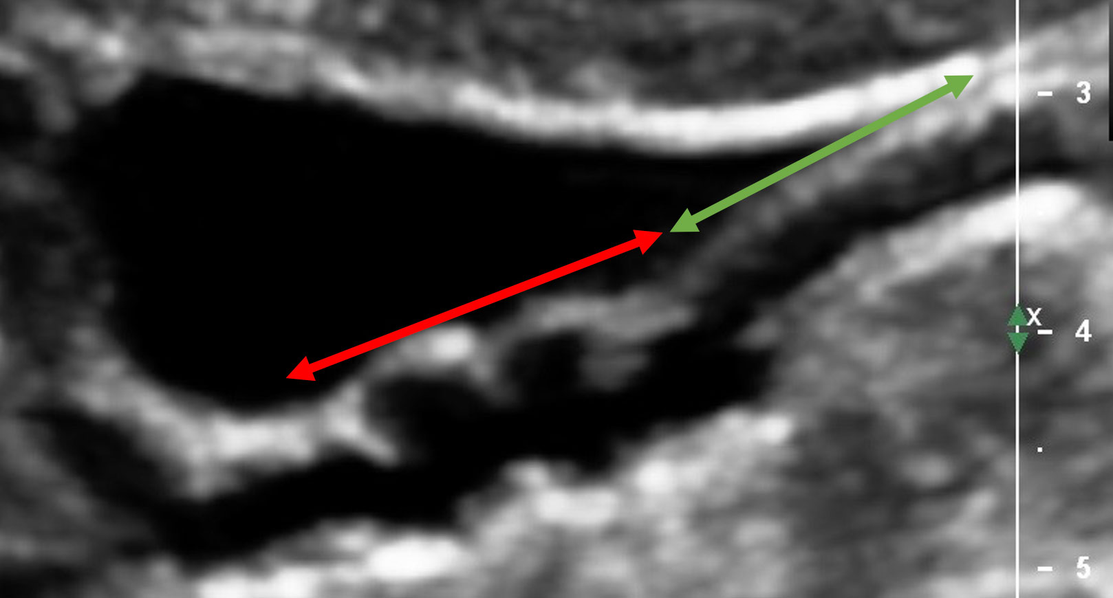 An internal carotid artery in longitudinal view, less than 50% stenosis