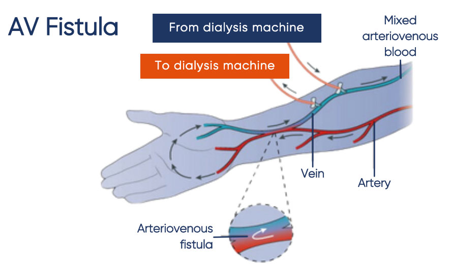 AV Fistula surgery for dialysis access Sydney