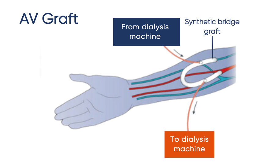 AV graft surgery for dialysis access Sydney