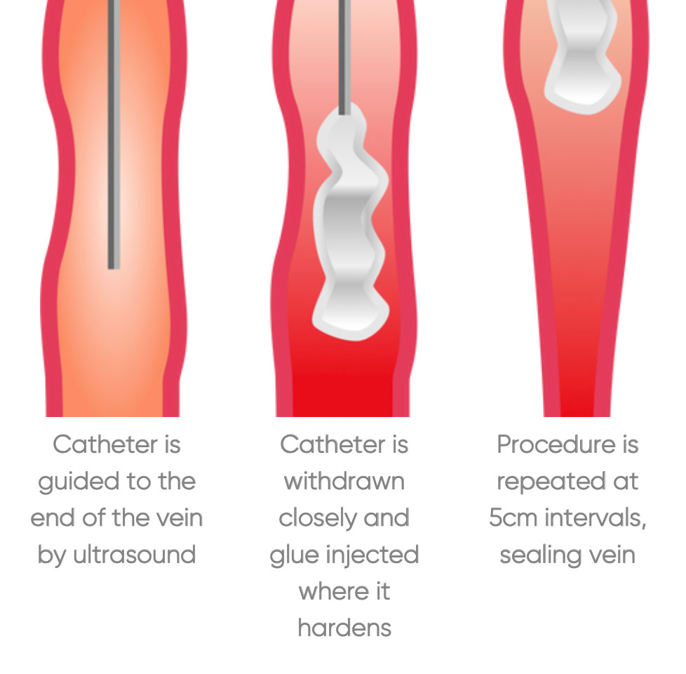 Endovenous glue treatment (EVLT) for Varicose Veins