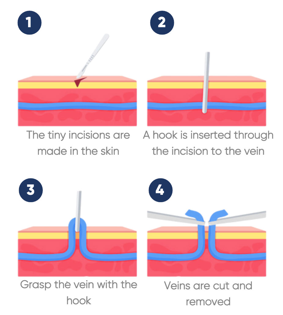 Ambulatory phlebectomy for Varicose Veins